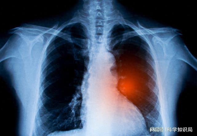 异常咳嗽是肺癌重要的报警信号 警惕夜间症状