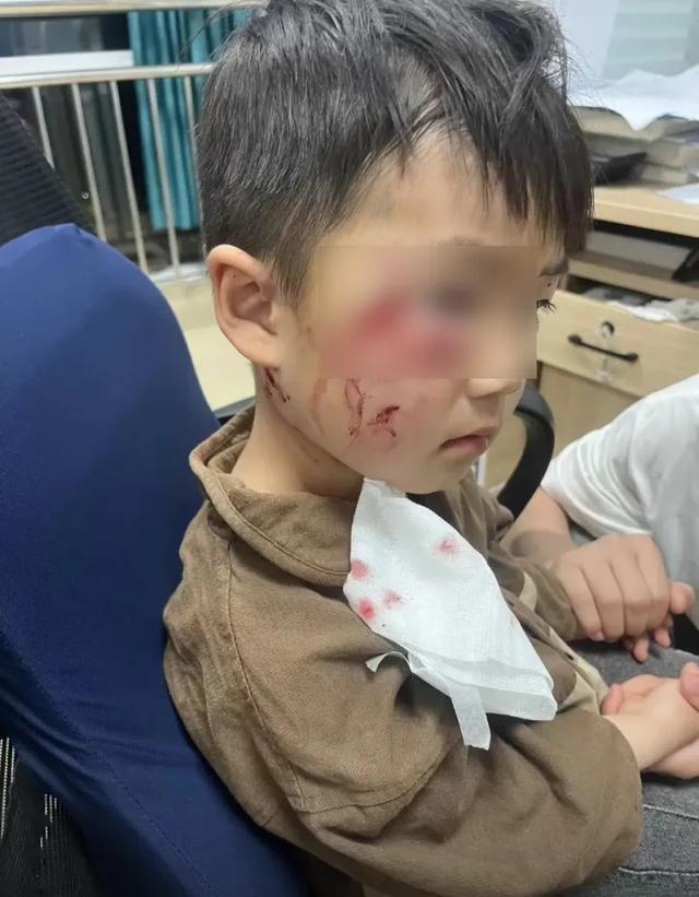 警方调查3岁男童路边被狗咬伤后死亡