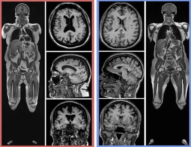 BMI超过26.2等于大脑老了12岁 肥胖如何加速脑衰老