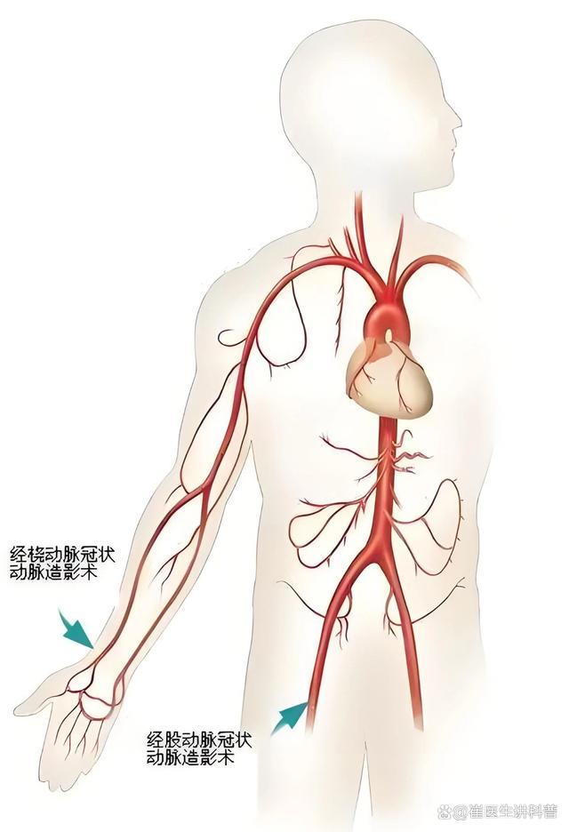 脑梗是哪里“堵”了？“取出”大脑看究竟 腔隙性脑梗死揭秘