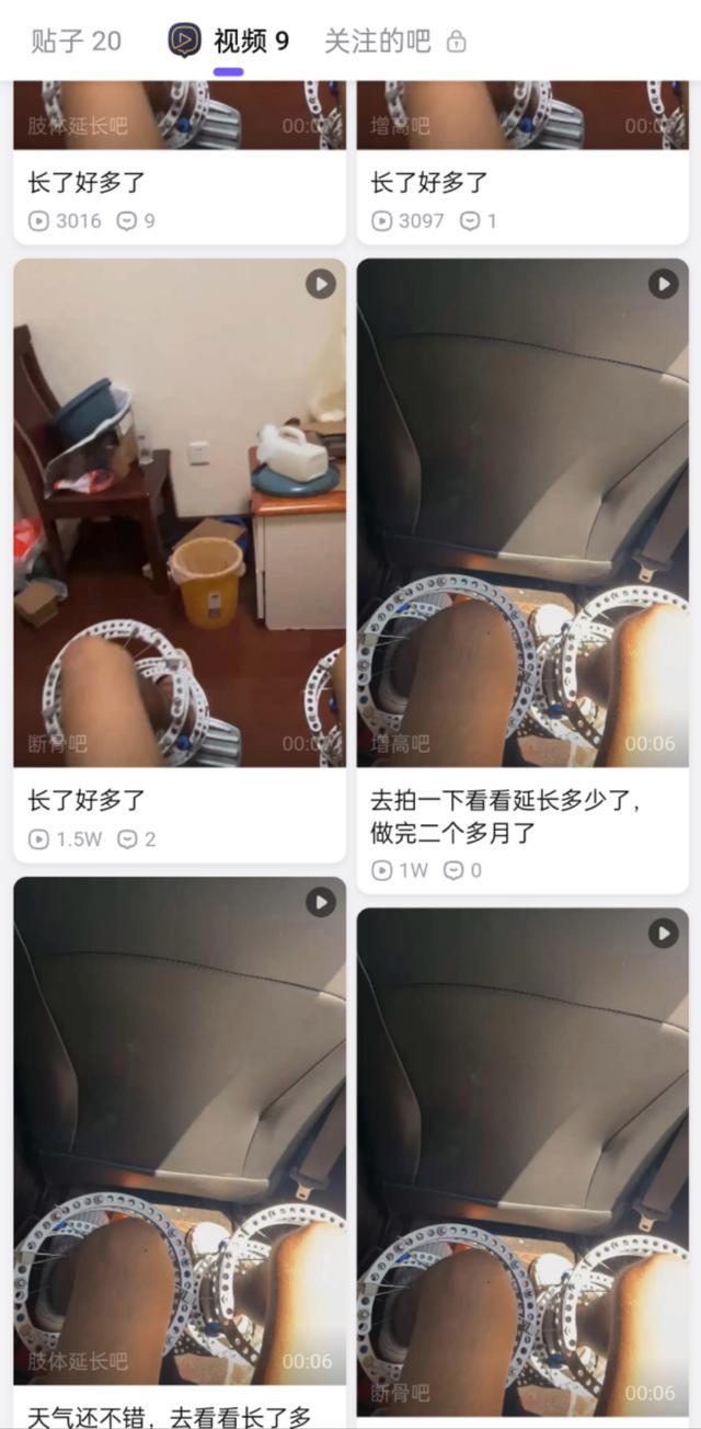 孤注一掷做“断骨增高”的人：术后无法快跑，关节发出异响“没有一天不后悔” 增高之痛与无尽悔恨