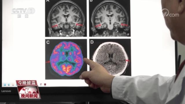 这些行为会提高患阿尔茨海默病风险 年轻人需警惕