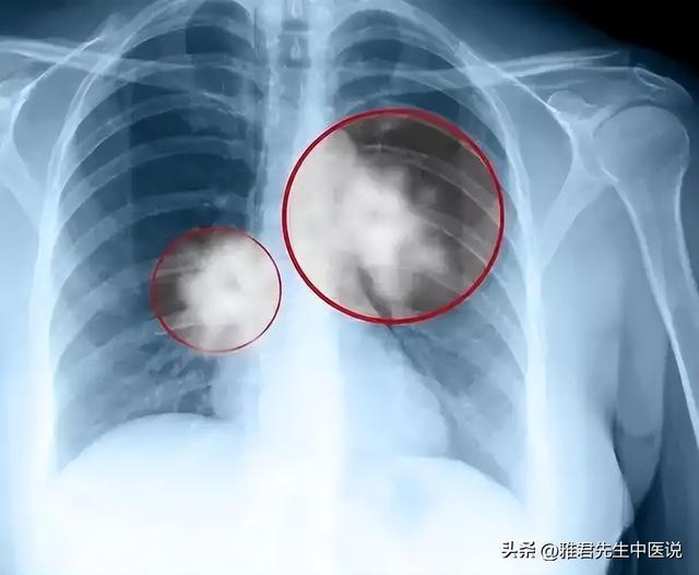 腿部出现3种异常可能是肺癌降临 警惕身体信号