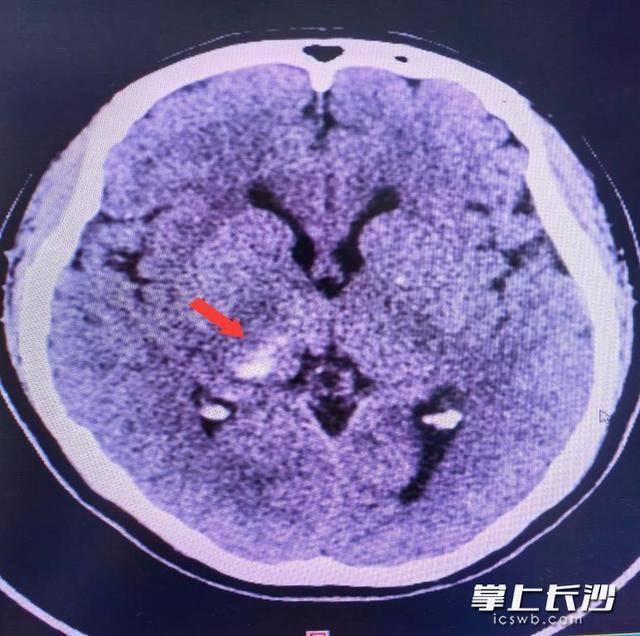 媽媽輔導(dǎo)6年級(jí)女兒作業(yè)氣到腦出血 情緒失控的警示