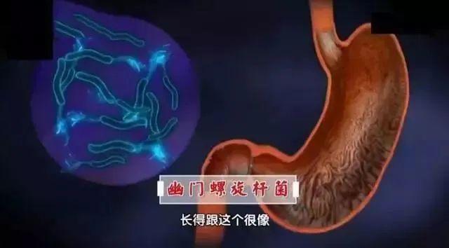 26岁女生因幽门螺旋杆菌确诊胃癌！