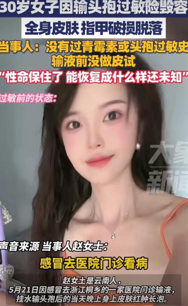 30岁女子因感冒输头孢过敏毁容 性命保住了能恢复成什么样子还是未知数