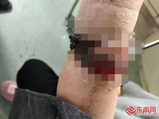 女子戴手镯十年没摘嵌进肉里 医生精细手术成功取出