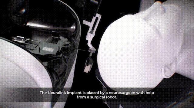 馬斯克機(jī)器人“開(kāi)顱插針”僅1.5秒 未來(lái)腦機(jī)接口手術(shù)效率飛躍