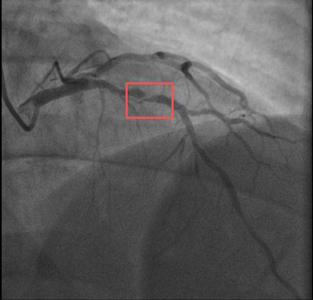 一天内,杭州两位38岁宝爸运动后倒下!医生:这些都是导火索!剧烈运动需谨慎