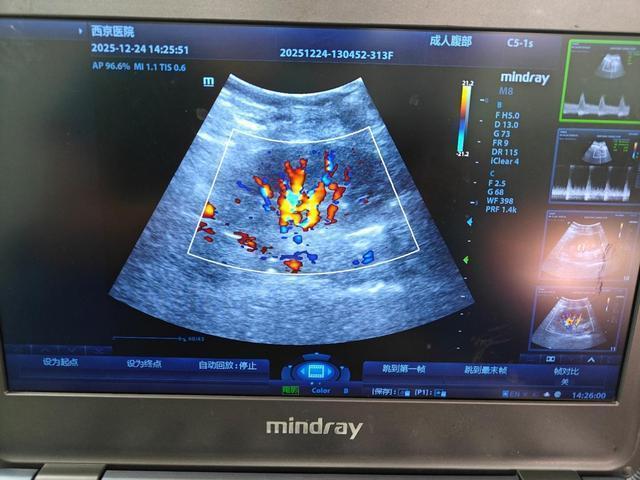 手术成功!妻子跨越血型障碍捐肾救夫