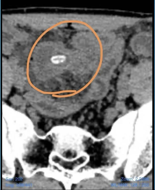 21岁男生腹痛手术取出整颗瓜子 罕见病因敲响警钟