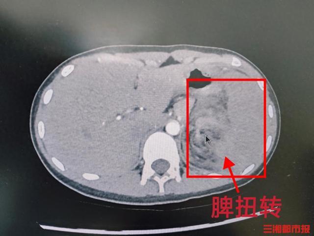 女童腹痛呕吐竟是罕见脾扭转