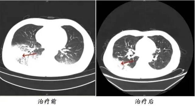78歲老人開(kāi)空調(diào)過(guò)夜肺變白了 警惕軍團(tuán)菌感染