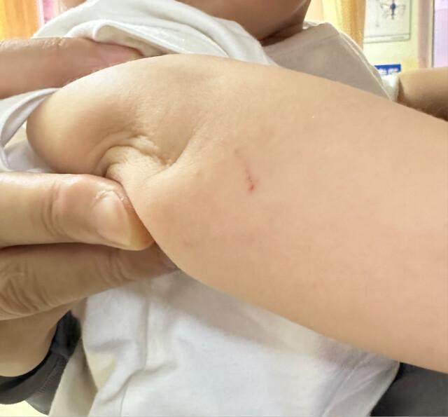 幼童小區(qū)玩耍被蛇咬傷 醫(yī)生提醒 低齡幼兒傷情隱蔽需警惕