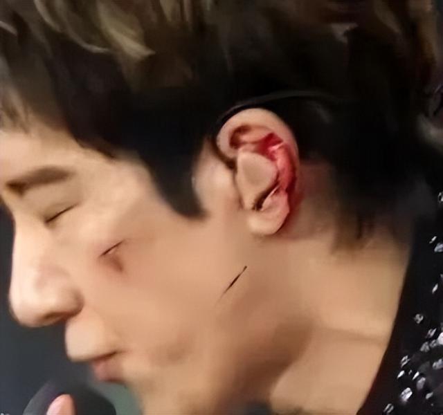 王力宏包扎后幽默回应：有点像梵高，敬业精神获赞