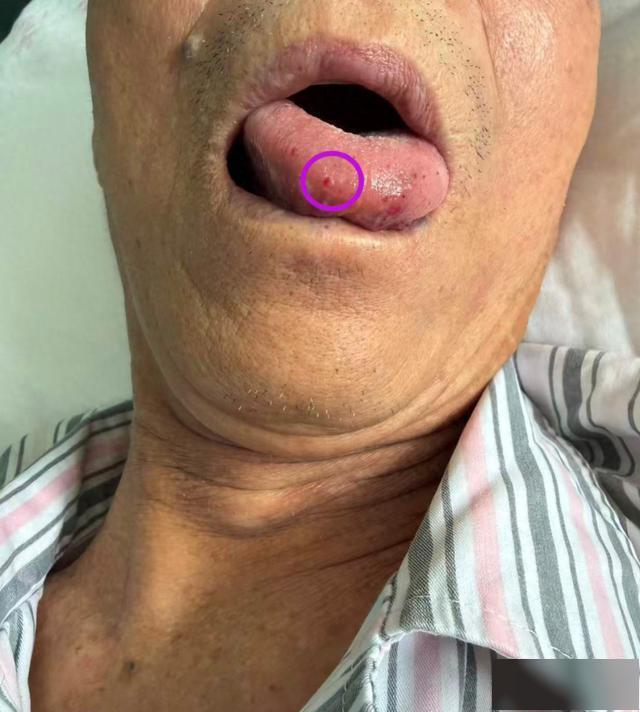 男子无三高却突发脑梗