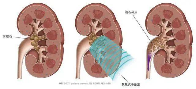 热搜第一！网友看演唱会后肾结石被“震碎”？医生：有可能