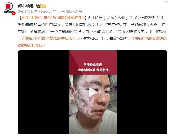 男子用餐廳毒紙巾擦臉險(xiǎn)毀容