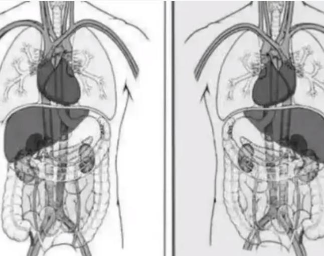 陕西宝鸡一女子五脏六腑长反了！百万人才有一例！