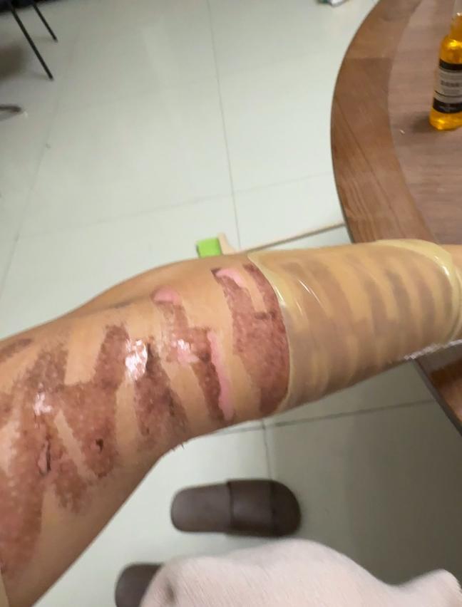女网红光子嫩肤被烧伤 医生：或留疤 医美风险需警惕