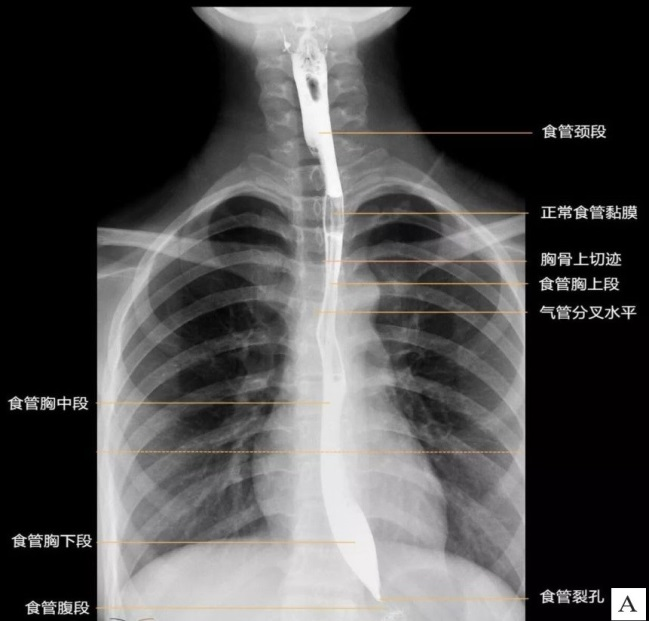 正常钡餐检查图像胸上段食管癌钡餐图像胸中段食管癌钡餐图像