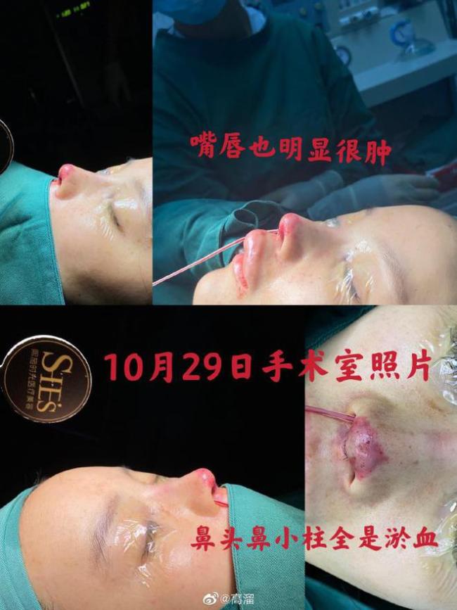 女演员高溜整容失败鼻尖坏死 院方：在走司法程序