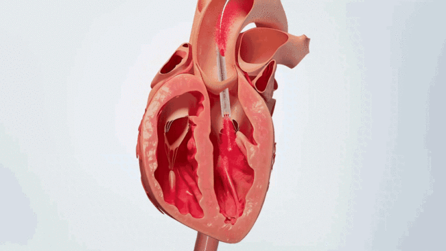 世界最小介入式人工心脏获美国FDA突破性设备认定