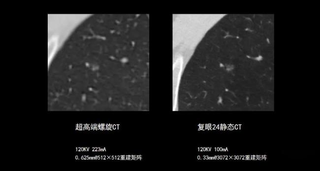 超高端螺旋CT与“复眼24”静态CT基于志愿者右肺上叶4mm肺结节的成像对比