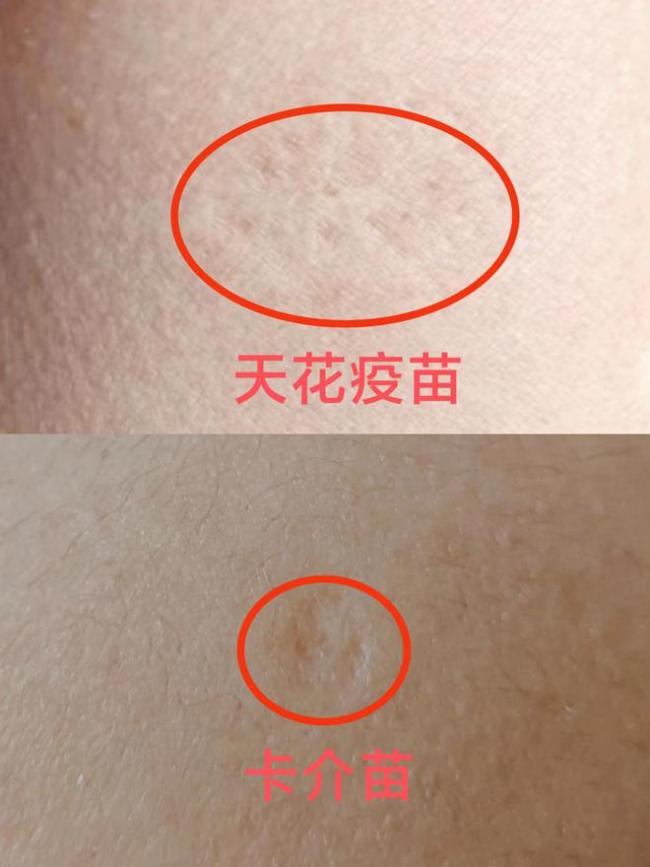 世卫最高级别警报！普通人该如何应对猴痘疫情？