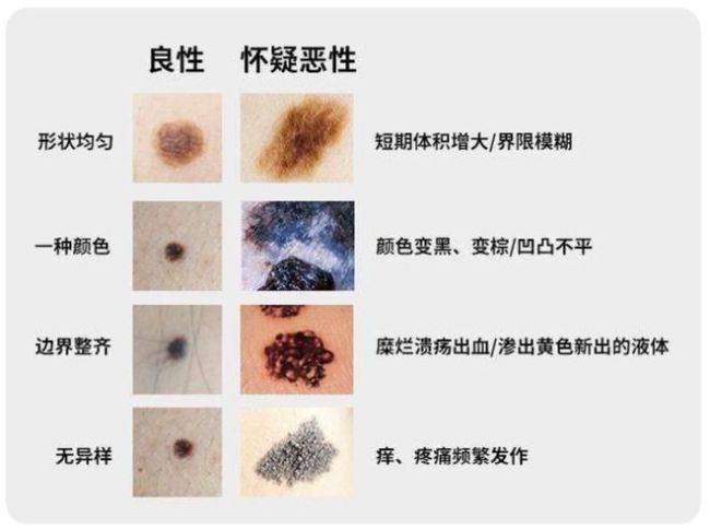 反复祛痣结果癌变，医生总结会癌变的痣5个特征