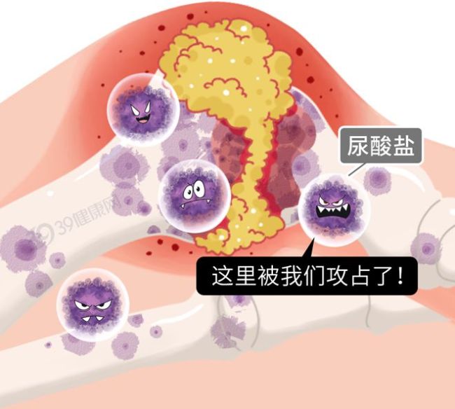 3种蔬菜嘌呤比肉还高，堪称“尿酸炸弹”！很多人还每天在吃