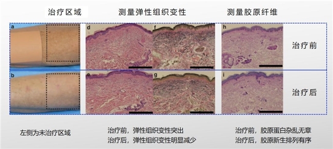 BBL HERO不止嫩肤 智启基因抗衰新纪元