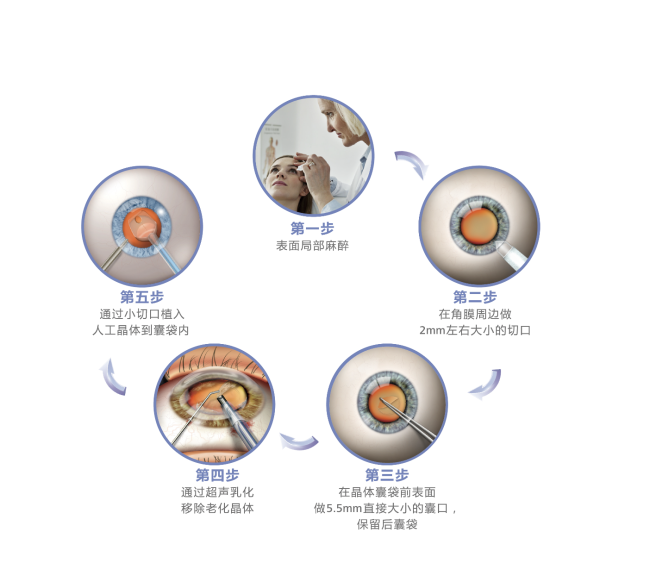 一文了解蔡司三焦点怎么样？