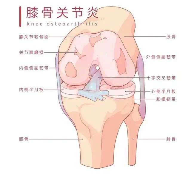 高强度运动警惕骨关节炎!氨基葡萄糖胶囊为关节健康护航