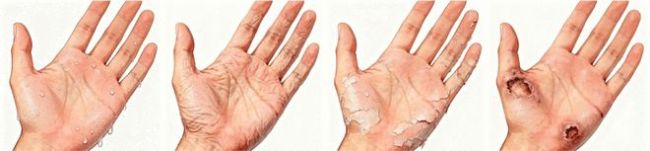 双手常年“湿漉漉”？别只当是“爱出汗”，可能是手汗症在困扰