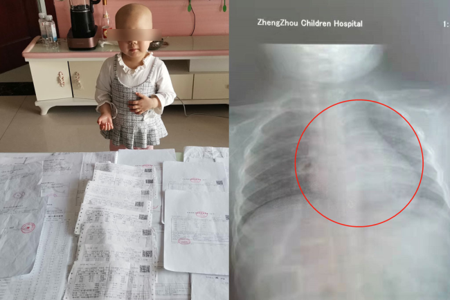 3岁女童胸腔肿瘤如成人拳头大小 父亲的心像被剜了一样疼