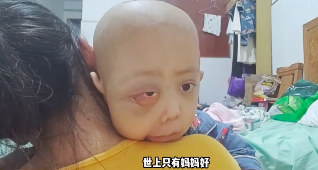 5岁男童患癌头部变形吓哭自己