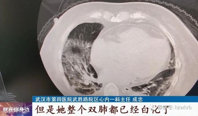 70岁老太没高烧不咳嗽，一查竟“白肺”！医生提醒：老人阳了，这几方面要加强监测