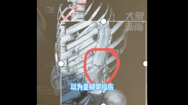 男子阳后连咳10多天把肋骨咳断！男子：哭笑不得