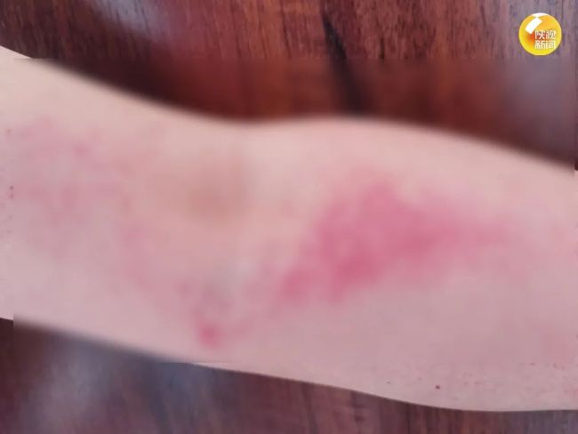 男子接触碎体温计水银致狒狒综合征：诱发因素水银位列第一