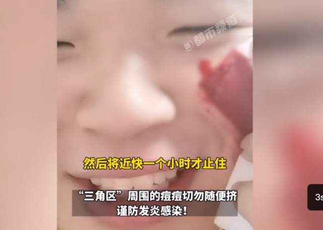 男生挤痘后流血近一小时：血量多时喷射出来