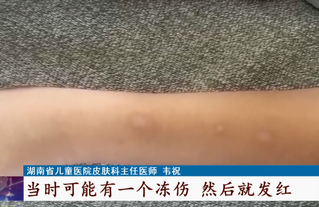 男童使用清凉喷雾被冻伤 网红产品谨慎使用！