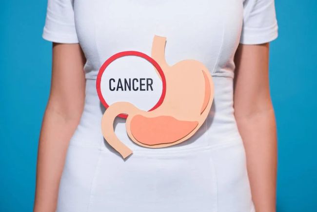 50岁以下人群癌症新发病例数激增 胃肠道癌早发性癌中增速最快