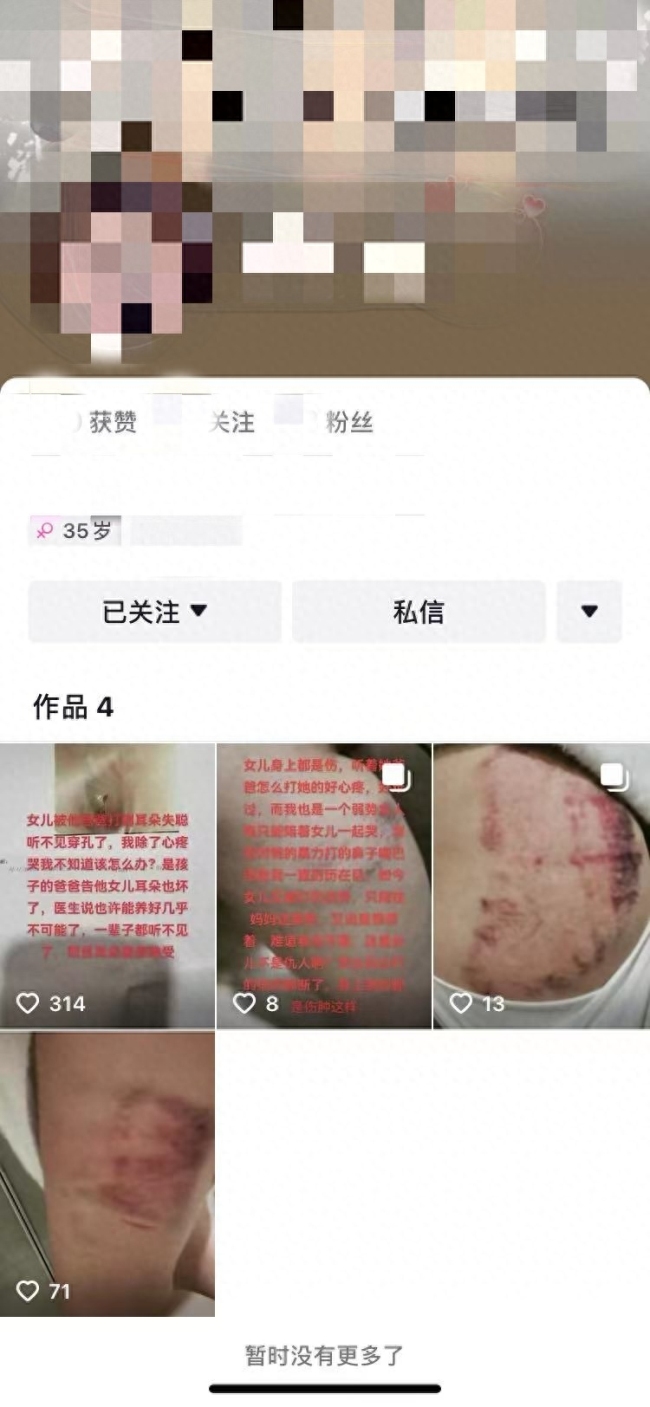 女孩因在女同事家留宿被后爸爸殴打，导致耳穿孔