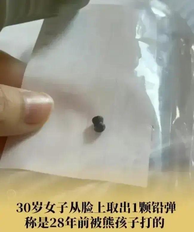 30岁女子从脸上取出铅弹在2岁时被小朋友用气枪打到了脸上