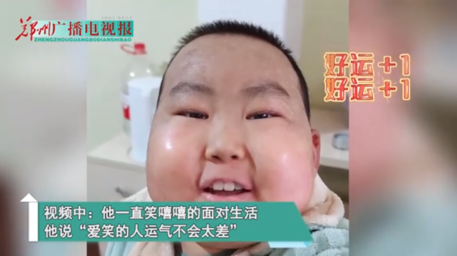 患病男孩肿成馒头脸仍笑对生活他说:“爱笑的人运气不会太差”