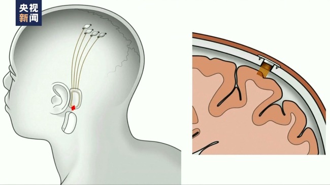 馬斯克：首位腦機接口設備人體移植者實現腦控鼠標