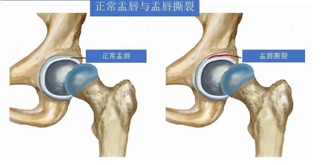 “16连蹲”火爆全网，医生提醒：不适合所有人模仿