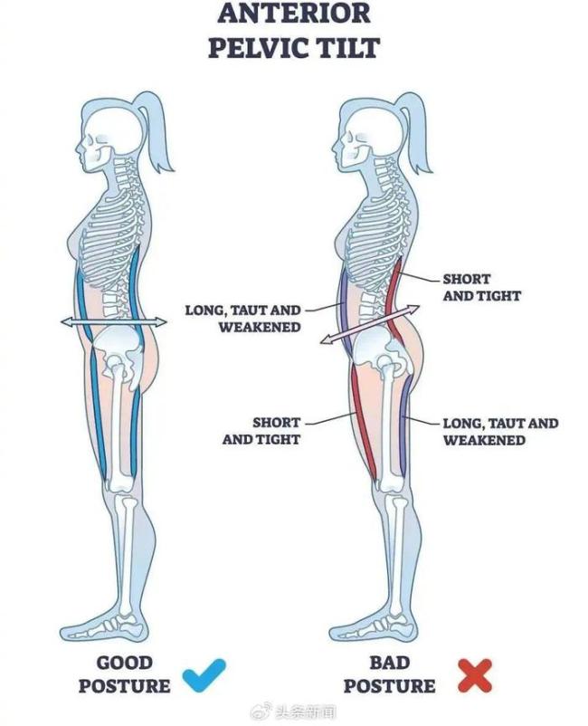 超80%的人骨盆都不正 揭秘人体“最贵容器”的隐忧与挑战