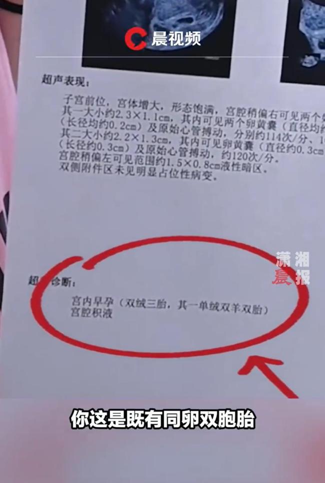 不孕女子喜获3胞胎同卵异卵同出现 医生惊呼第一次见